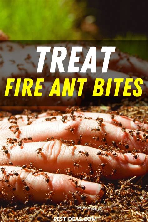 best treatment for fire ant bites